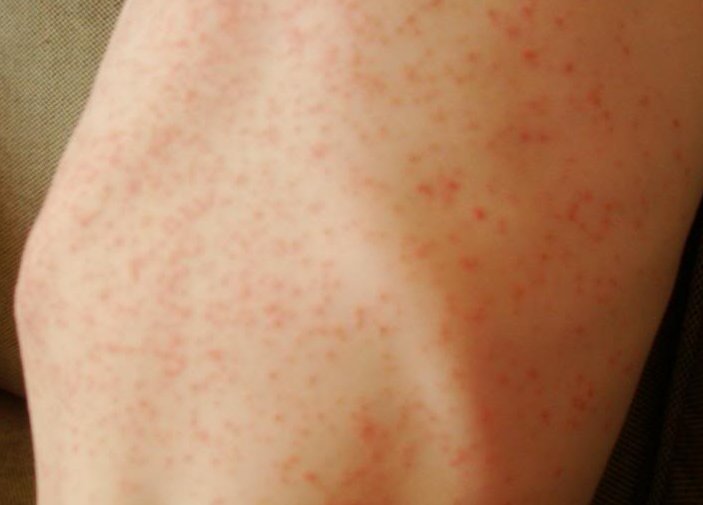 heat rash pictures in babies. Heat+rashes+on+abies